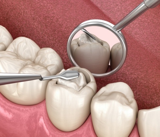 Animated close up of dental mirror next to tooth with dental fillings in Fort Worth