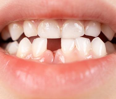 Patient in Fort Worth with tooth gaps