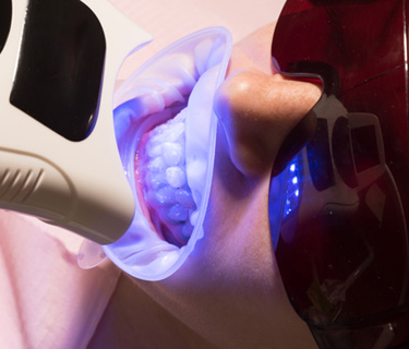 Patient undergoing in-practice teeth whitening